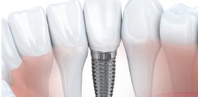 Dental Implants Stroud