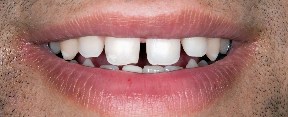 Veneers Before