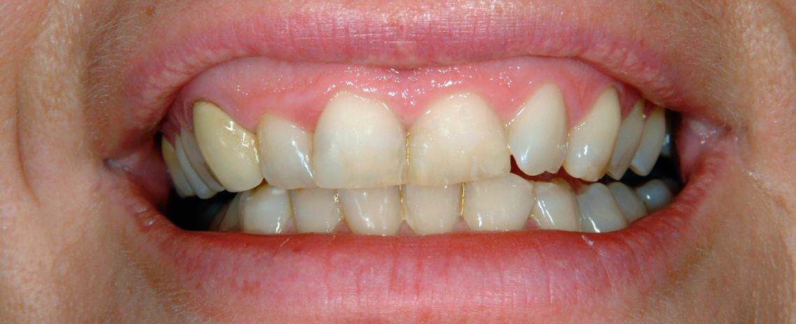 Veneers Before