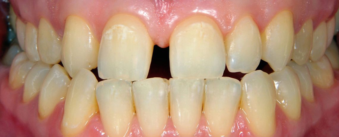 Teeth Straightening and Whitening Before