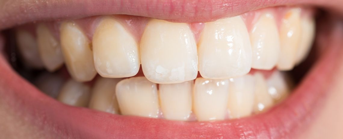 Teeth Whitening Before