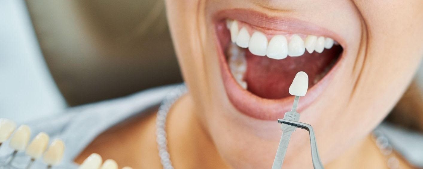 Special Offer on ZOOM! Home Teeth Whitening 